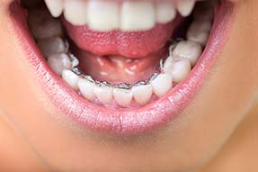 Young woman showing lingual braces, close up